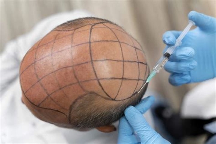 
Darts Champion Raymond Van Barneveld Undergo Hair Transplant Procedure Due To Insecurities 