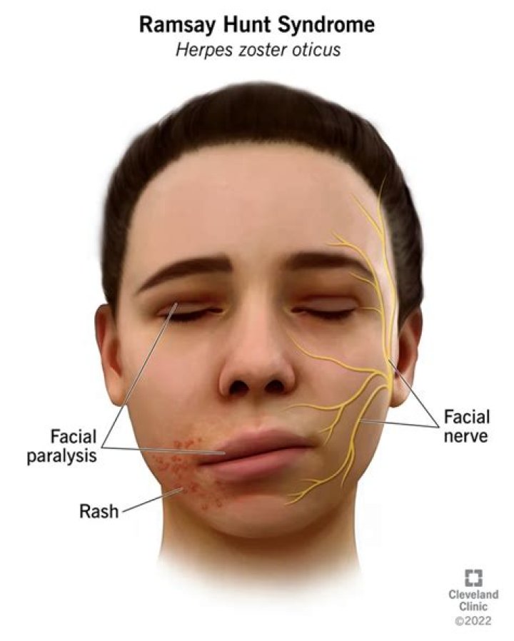 
Is Ramsay Hunt Syndrome Permanent? Justin Bieber Paralyzed Face Illness Explained 