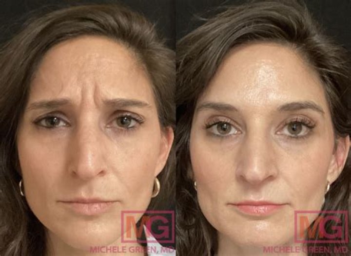 
Kyle Richards’ Botox, Before And After Photos: Has She Done Nose Job And Lip Filler 
