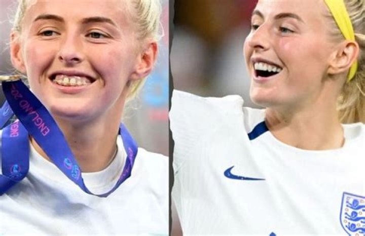 
What Is Wrong With Chloe Kelly Teeth? Face And Nose Injury – Does She Use Braces? 